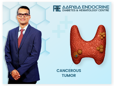 Thyroid Cancer