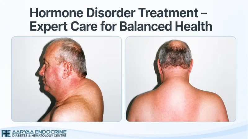 Hormone Disorder Treatment – Expert Care for Balanced Health