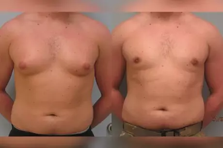 Gynecomastia